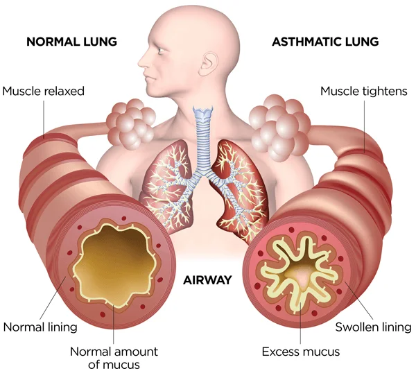 asthma-1a